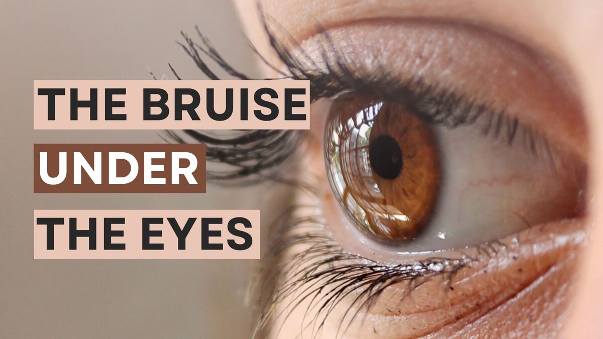 The Bruise Under the Eyes - How to remove?